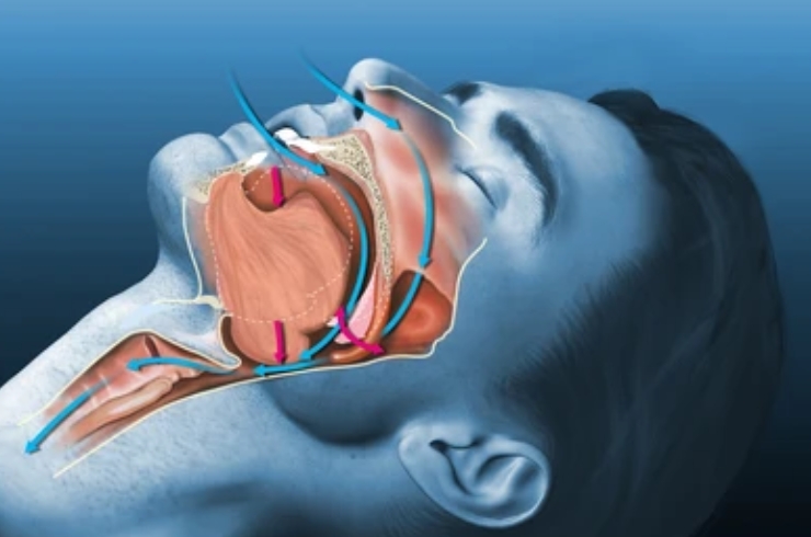 Sleep Apnea & Snoring Solutions-------19